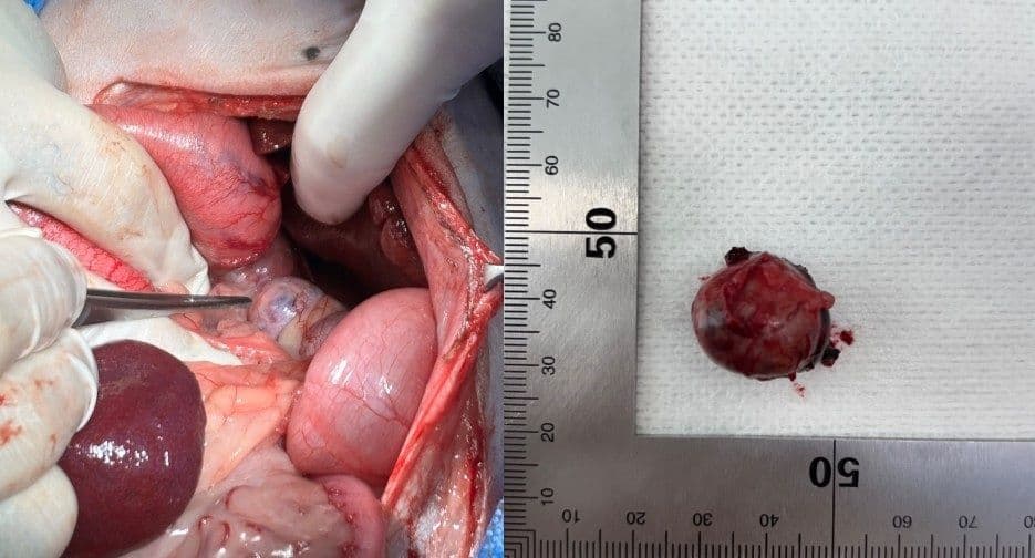 부신 종양 (Adrenal Tumor)