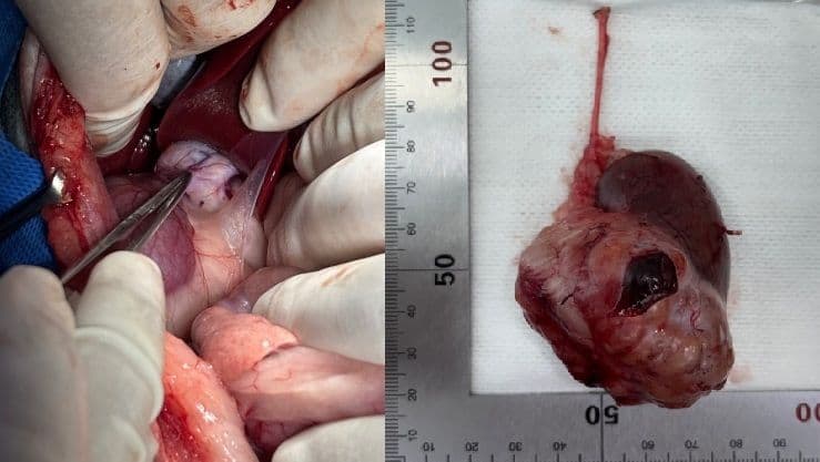 신장 종양 (Kidney Tumor)