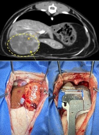 간 종양 (Liver Tumor)